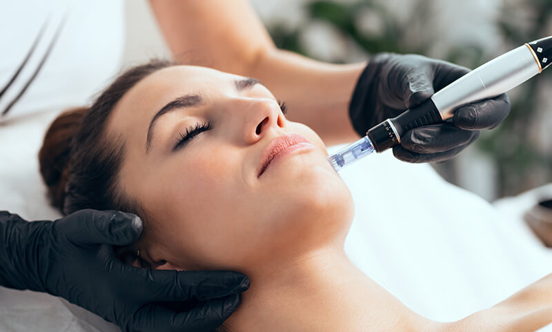 microneedling-2