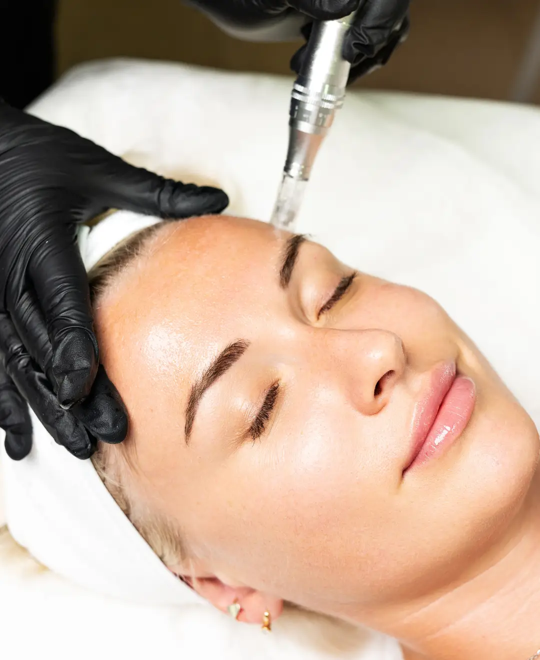 Behandlung RF-Microneedling in Rüsselsheim, Wiesbaden, Mainz und Frankfurt bei Salmana Medical Beauty.